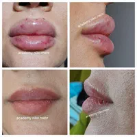 مدل بوتاکس ژل مزوتراپی میکرونیدلینگ فشیال|خدمات آرایشگری و زیبایی|فردیس, طالقانی|دیوار