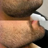 تزریق ژل فیلر بوتاکس مزوتراپی مزوژل لیزر فیشیال|خدمات آرایشگری و زیبایی|کرج, گوهردشت|دیوار
