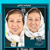 پایتخت ایمپلنت دندان دندانپزشکی تضمینی تعرفه دولتی|خدمات آرایشگری و زیبایی|شیراز, معالی‌آباد|دیوار