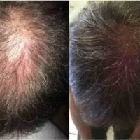 جشنواره مزو تراپی مو رویتاکر revitacare