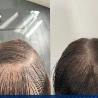ریزش مو|آرایشی، بهداشتی، درمانی|شیراز, دباغ خانه|دیوار