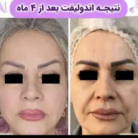 پکیج اقتصادی جوانسازی و لیفت اندوهایفو دکتر داریوش|خدمات آرایشگری و زیبایی|مشهد, راهنمایی|دیوار