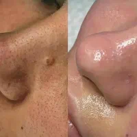 رفع تخصصی انواع جوش منافذ، لک و خشکی کلینیک لوکس