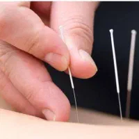 طب سوزنی و حجامت