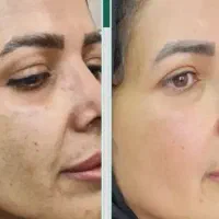 تخفیفات محدود مزوتراپی پوست و مو