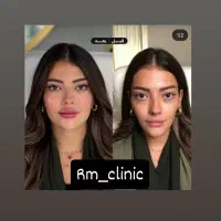 ۵۰ درصد تخفیف تزریق صورت سبک عربی هالیوودی لب روسی|خدمات آرایشگری و زیبایی|ری, دیلمان|دیوار