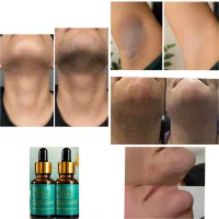رفع دائم موهای زائد بدون لیزر (پرداخت درب منزل)