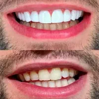 کامپوزیت دندان /طرح لبخند( اقساط)|خدمات آرایشگری و زیبایی|مشهد, راهنمایی|دیوار