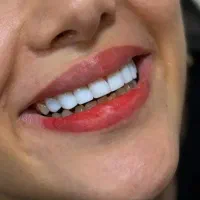 دندانپزشکی(لمینیت،ایمپلنت،دندان مصنوعی)شرایط اقساط|خدمات آرایشگری و زیبایی|اصفهان, لاله|دیوار
