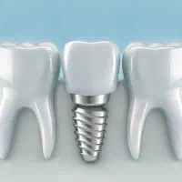 دستیار ایمپلنت دندانپزشکی