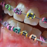 ارتودنسی ثابت و متحرک با اقساط بلند مدت