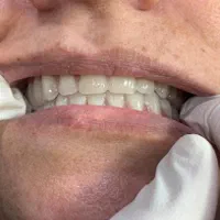 روکش های دندانی(پروتز های دندانی)|خدمات آرایشگری و زیبایی|ارومیه, |دیوار