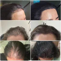 میکرواسکالپ / مکمل کاشت مو|خدمات آرایشگری و زیبایی|دوگنبدان, |دیوار