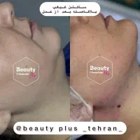 تخفیف ساکشن شکم پهلو و پشت/ هر ناحیه از بدن/بلفارو|خدمات آرایشگری و زیبایی|قم, زنبیل آباد|دیوار