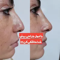 اصلاح قوز و افتادگی بینی بدون جراحی در مطب20%تخفیف|خدمات آرایشگری و زیبایی|شاهین‌شهر, فردوسی|دیوار