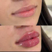تزریق ژل .بوتاکس .انزیم بینی .مزوژل جوانساز|خدمات آرایشگری و زیبایی|جهرم, |دیوار