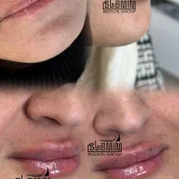 تزریق فیلر-بوتاکس-جوانسازی صورت