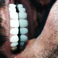 کامپوزیت دندان طرح لبخند جرمگیری بلیچینگ پالیش|خدمات آرایشگری و زیبایی|اهواز, نادری|دیوار
