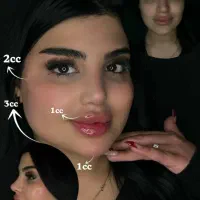 تزریق ژل وبوتاکس از۴۹۰فقط تا۴شنبه