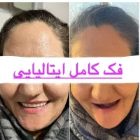 دندانسازی / دندان مصنوعی/ جوان پسند لمینتی/اقساط|خدمات آرایشگری و زیبایی|مشهد, عبادی|دیوار