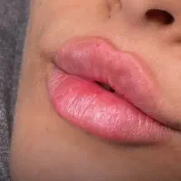 ژل و بوتاکس ، فیشال ، لیفت ابرو و مژه