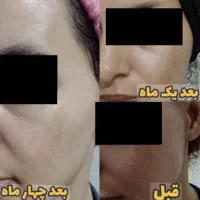 کرم سوپر معجزه