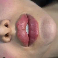 ژل و بوتاکس