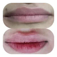 تخفیف ژل و بوتاکس فقط به مدت ۳ روز