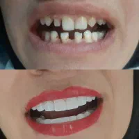 کامپوزیت زیبایی دندان درکلینیک دندانپزشکی|خدمات آرایشگری و زیبایی|یاسوج, |دیوار