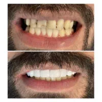 دندانپزشکی کامپوزیت تعرفه دولتی