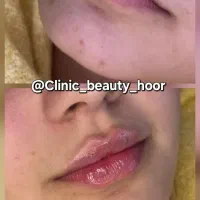 جشنواره تزریق ژل و فیلر بوتاکس کانتورینگ توسط پزشک|خدمات آرایشگری و زیبایی|سنندج, |دیوار