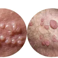 بهبود بیماری های‌آمیزشی hsvو hpv