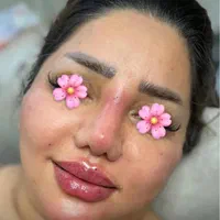 تزریق ژل و بوتاکس|خدمات آرایشگری و زیبایی|تهران, عبدل‌آباد|دیوار