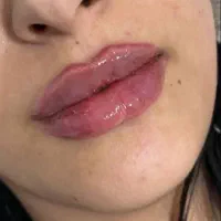 فیلر و بوتاکس