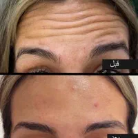 جشنواره تخفیفات ویژه عملهای زیبایی پلک و بینی و ..|خدمات آرایشگری و زیبایی|شیراز, زرگری|دیوار