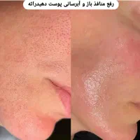 فیشال تخصصی پوست و لیفت لمینت ابرو
