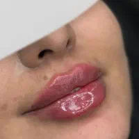 تزریق ژل و بوتاکس در منزل بنده و کلینیک فقط ۷۰۰