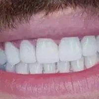ایمپلنت آلمانی و کره‌ای ،روکش رایگان 15/600+ اقساط