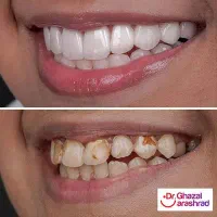 مدل برای ونیر کامپوزیت و لمینیت