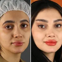 بلفاروپلاستی لیفت صورت بوکال فت تزریق چربی|خدمات آرایشگری و زیبایی|کرمانشاه, |دیوار