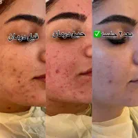 پاکسازی درمانی و تخصصی پوست برا خانم ها و آقایان