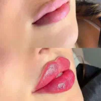 فیلر بوتاکس،مزو، نخ