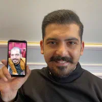 کاشت مو و ابرو بدون جراحی تخفیف ویژه اقساطی تبریز