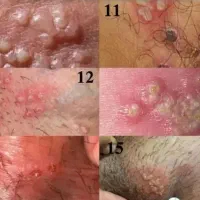 زگیل و تبخال و کامل از بین ببر|آرایشی، بهداشتی، درمانی|شاندیز, |دیوار