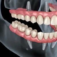 کاشت ایمپلنت دیجیتال/قیمت ویژه/ضمانت کتبی|خدمات آرایشگری و زیبایی|اصفهان, شفق|دیوار