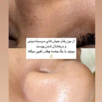 نیاز به مدل پاکسازی پوست تخصصی|خدمات آرایشگری و زیبایی|ساری, |دیوار