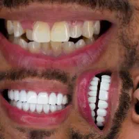 کامپوزیت دندان