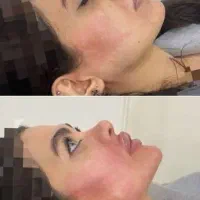 جشنواره ژل لب فیلر زیرچشم بوتاکس،هایفوکلینیک معتبر|خدمات آرایشگری و زیبایی|کرج, گوهردشت|دیوار