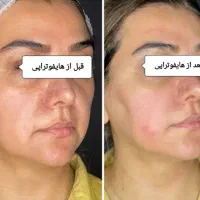 مرکز تخصصی جوانسازی اندولیفت/انواع هایفو/لیفت ۸۵۰ت|خدمات آرایشگری و زیبایی|اصفهان, احمدآباد|دیوار
