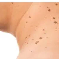 فروش مواد زگیل تناسلی تضمینی با ی بار استفاده|خدمات آرایشگری و زیبایی|یاسوج, |دیوار